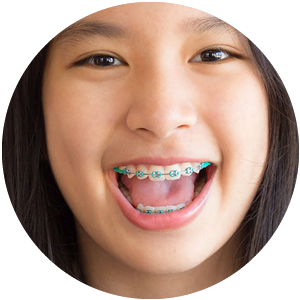 Colored Braces