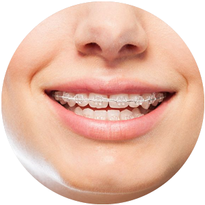 Hybrid Braces