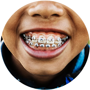 Traditional Braces