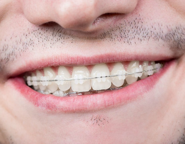 clear-braces Clear Braces