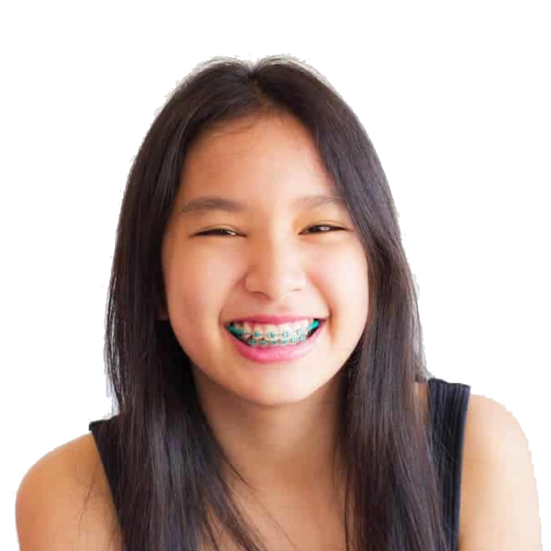 colored-braces-2 Colored Braces photo