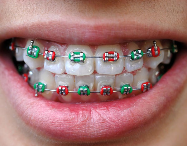 colored-braces Colored Braces photo