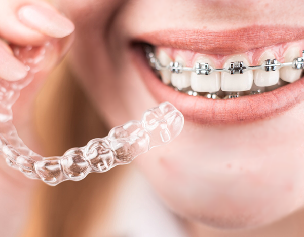 hybrid-braces Hybrid Braces