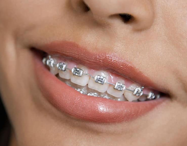 traditional-braces traditional braces